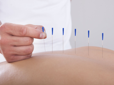 الإبر الصينية (Acupuncture)